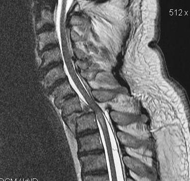 Cervical Spine MRI Subaxial Subluxation